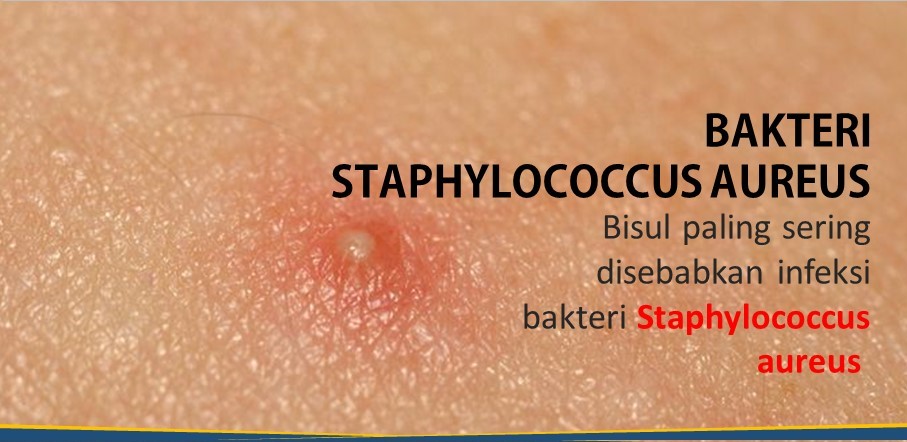 Ramuan Tradisional Mengobati Bisul